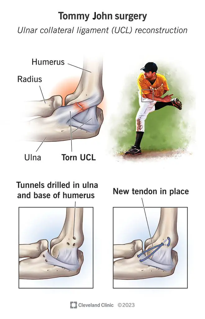 Impacto de la cirugía Tommy John en el beisbol moderno y su historia